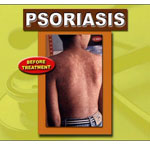 PSURIASIS