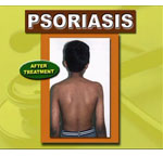 PSURIASIS